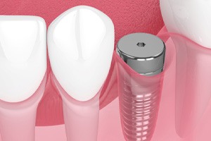 Digital illustration of dental implants