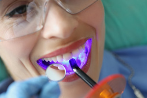 a patient smiling while receiving dental sealants
