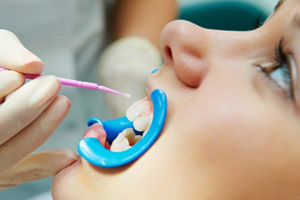 a dental patient undergoing fluoride treatment