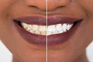 Patient's smile before and after teeth whitening treatment